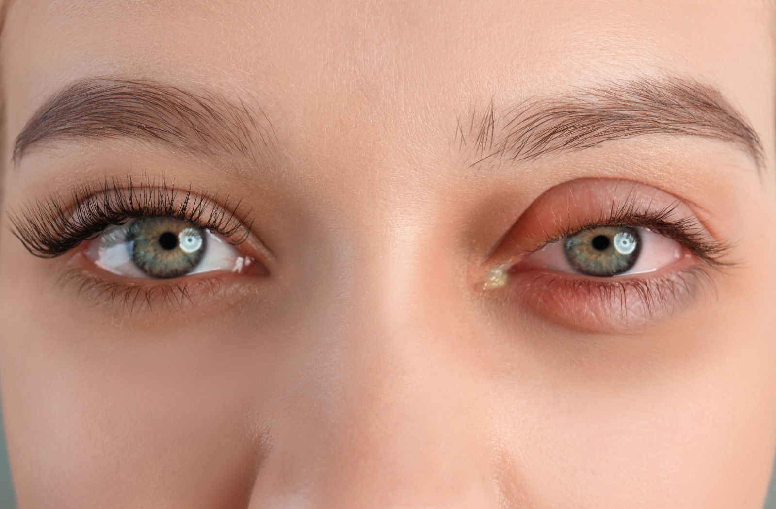 Close-up of an eye showing symptoms of conjunctivitis (pink eye) with redness and irritation in one eye.